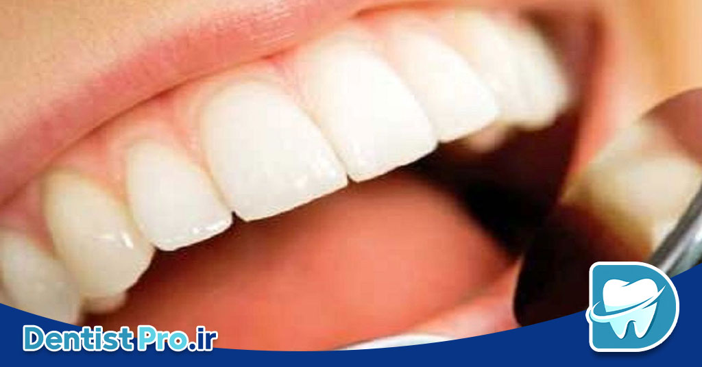 اثر دیابت بر لثه ها: چگونه دیابت سلامت لثه‌ها را تحت تأثیر قرار می‌دهد؟