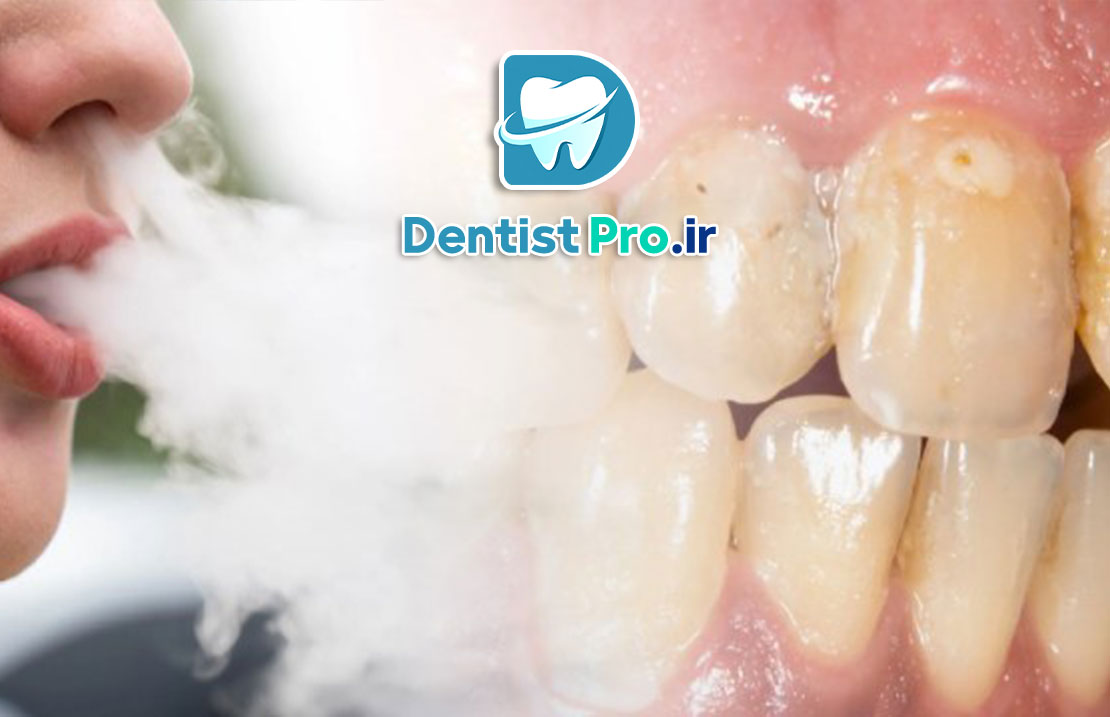 اثر سیگار بر لثه: پیامدهای مصرف سیگار بر سلامت لثه و راهکارهای پیشگیری