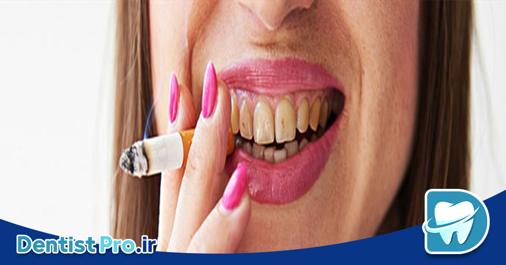 اثر سیگار بر لثه: پیامدهای مصرف سیگار بر سلامت لثه و راهکارهای پیشگیری