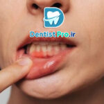 نقش تغذیه در پیشگیری از تحلیل لثه: کلید حفظ سلامت لثه‌ها و جلوگیری از تخریب بافت