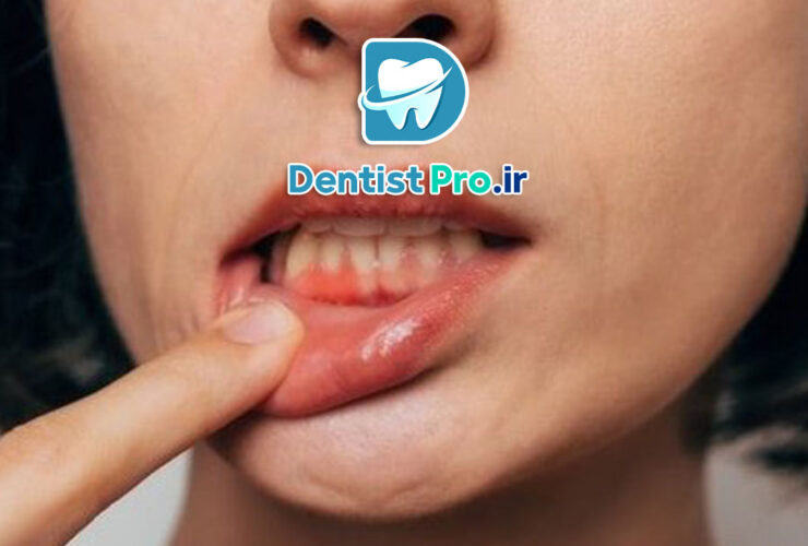 نقش تغذیه در پیشگیری از تحلیل لثه: کلید حفظ سلامت لثه‌ها و جلوگیری از تخریب بافت