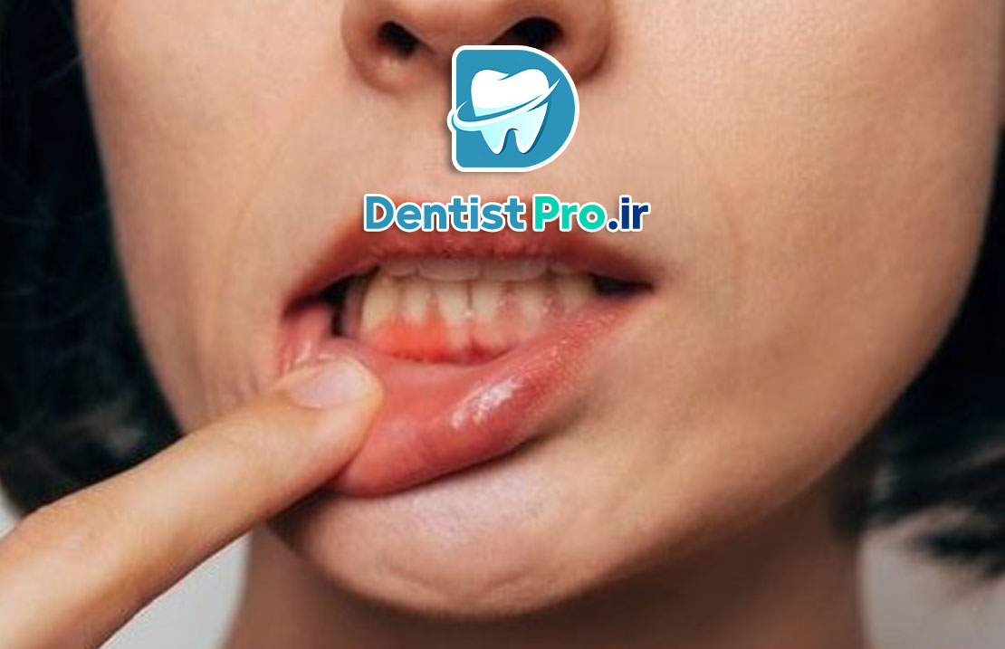 نقش تغذیه در پیشگیری از تحلیل لثه: کلید حفظ سلامت لثهها و جلوگیری از تخریب بافت 25 نقش تغذیه در پیشگیری از تحلیل لثه: کلید حفظ سلامت لثهها و جلوگیری از تخریب بافت