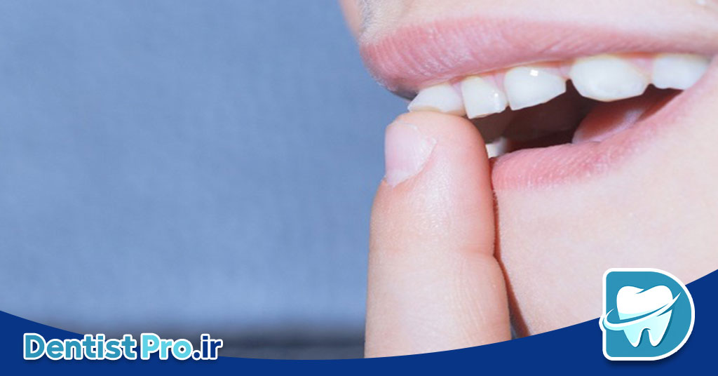 نقش تغذیه در پیشگیری از تحلیل لثه: کلید حفظ سلامت لثهها و جلوگیری از تخریب بافت 28 نقش تغذیه در پیشگیری از تحلیل لثه: کلید حفظ سلامت لثهها و جلوگیری از تخریب بافت