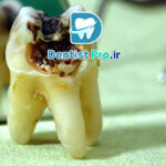 پوسیدگی عاج دندان؛ بررسی علل، علائم و روش‌های درمانی