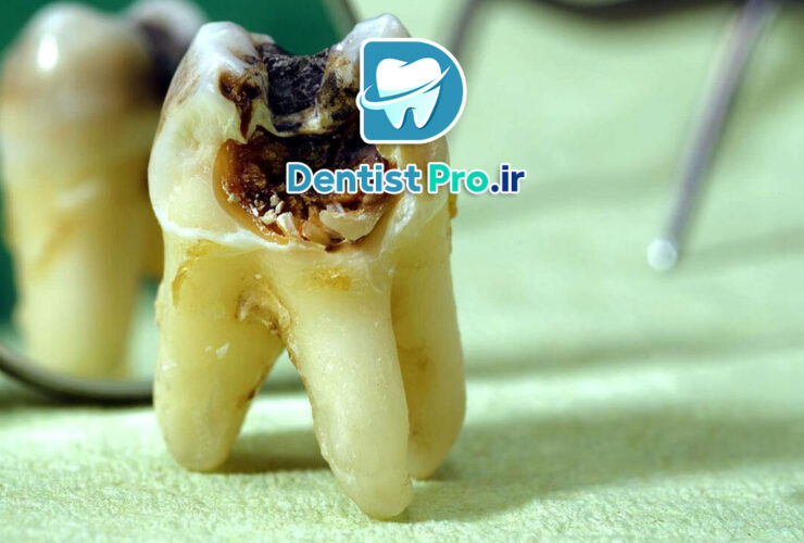 پوسیدگی عاج دندان؛ بررسی علل، علائم و روش‌های درمانی
