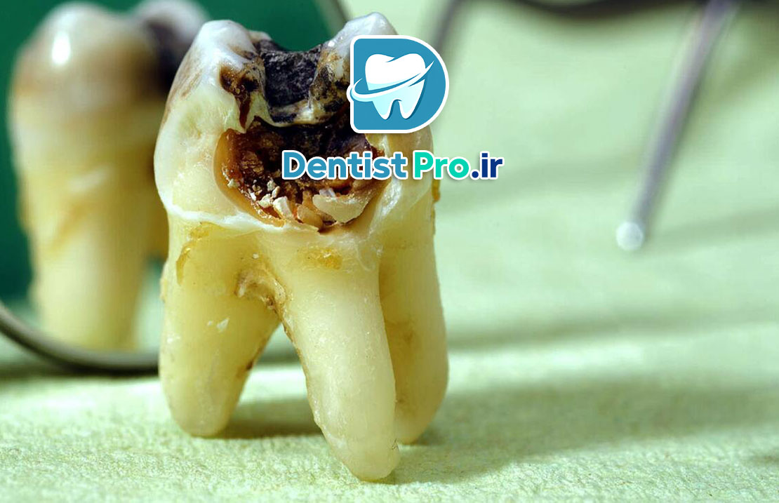 پوسیدگی عاج دندان؛ بررسی علل، علائم و روش‌های درمانی