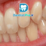 فرم دهی مینای دندان چیست؟