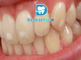 فرم دهی مینای دندان چیست؟