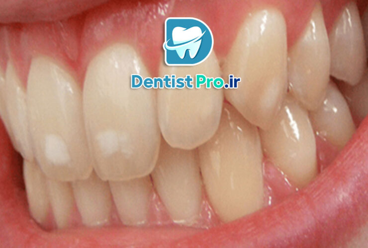 فرم دهی مینای دندان چیست؟