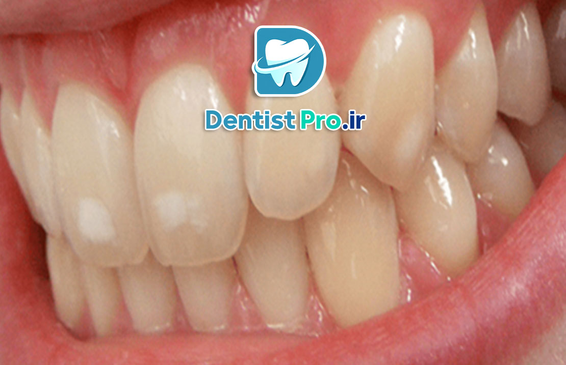 فرم دهی مینای دندان چیست؟ 25 فرم دهی مینای دندان چیست؟