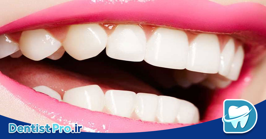 فرم دهی مینای دندان چیست؟ 28 فرم دهی مینای دندان چیست؟