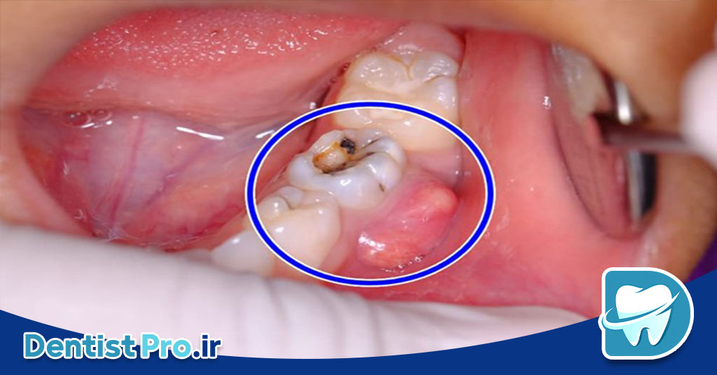 درمان آبسه لثه بدون آنتی بیوتیک