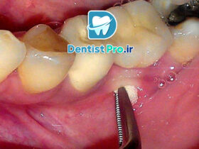 درمان آبسه لثه بدون آنتی بیوتیک