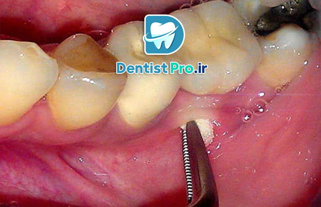 درمان آبسه لثه بدون آنتی بیوتیک
