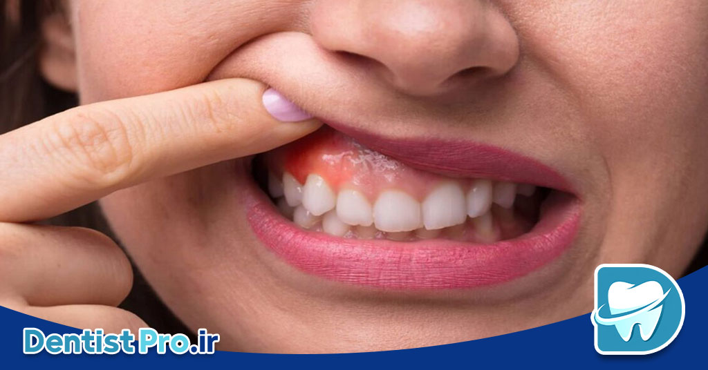 درمان آبسه دندان بدون جراحی: راهکارهای موثر و کم تهاجمی 28 درمان آبسه دندان بدون جراحی: راهکارهای موثر و کم تهاجمی