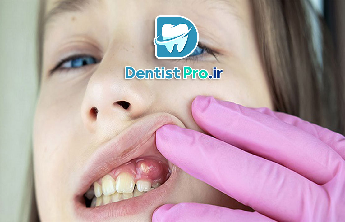 درمان آبسه دندان بدون جراحی: راهکارهای موثر و کم تهاجمی 25 درمان آبسه دندان بدون جراحی: راهکارهای موثر و کم تهاجمی