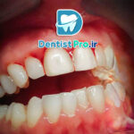 درمان خونریزی لثه در خانه+ موارد 100% حیاتی