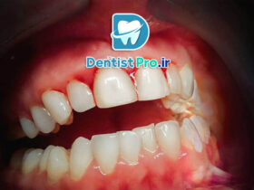 درمان خونریزی لثه در خانه+ موارد 100% حیاتی