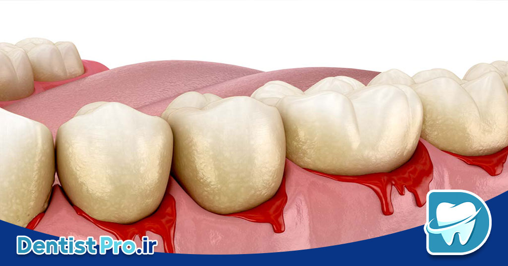 درمان خونریزی لثه در خانه؛ راهکارهایی ساده اما مؤثر 28 درمان خونریزی لثه در خانه؛ راهکارهایی ساده اما مؤثر