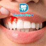 درمان خونریزی لثه در خانه؛ راهکارهایی ساده اما مؤثر