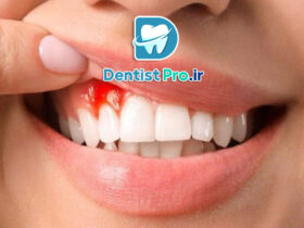 درمان خونریزی لثه در خانه؛ راهکارهایی ساده اما مؤثر