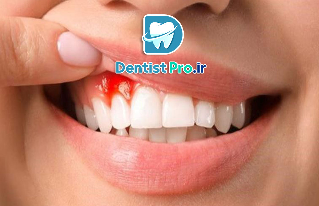 درمان خونریزی لثه در خانه؛ راهکارهایی ساده اما مؤثر 25 درمان خونریزی لثه در خانه؛ راهکارهایی ساده اما مؤثر