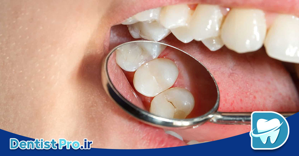 درمان پوسیدگی دندان در مراحل اولیه: پیشگیری بهتر از درمان