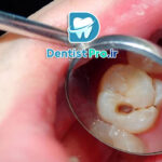 درمان پوسیدگی دندان در مراحل اولیه: پیشگیری بهتر از درمان