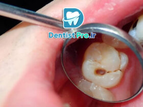 درمان پوسیدگی دندان در مراحل اولیه: پیشگیری بهتر از درمان