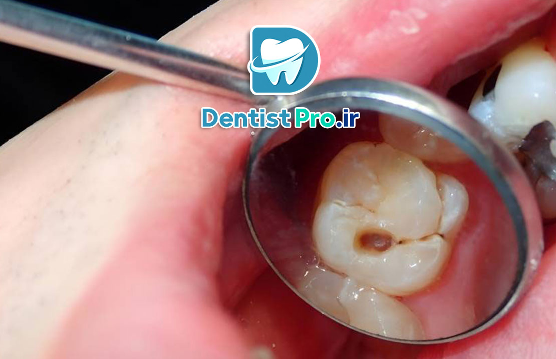 درمان پوسیدگی دندان در مراحل اولیه: پیشگیری بهتر از درمان