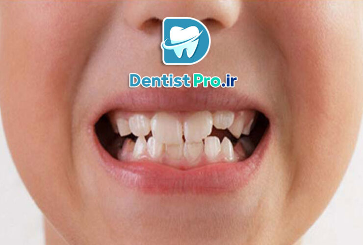 درمان لب پریدگی دندان کودک: راهنمای کامل والدین برای ترمیم دندانهای آسیبدیده کودکان 27 درمان لب پریدگی دندان کودک: راهنمای کامل والدین برای ترمیم دندانهای آسیبدیده کودکان