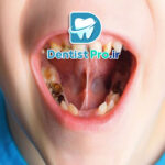 درمان پوسیدگی عمیق دندان شیری: راهکارها، روش‌ها و مراقبت‌ها