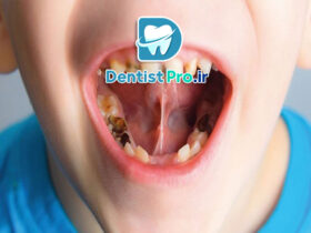 درمان پوسیدگی عمیق دندان شیری: راهکارها، روش‌ها و مراقبت‌ها