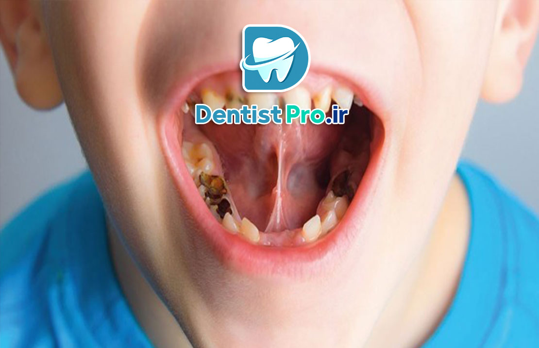 درمان پوسیدگی عمیق دندان شیری: راهکارها، روش‌ها و مراقبت‌ها