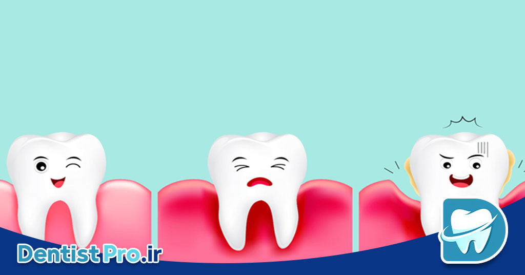 درمان خونریزی مکرر لثه ها چیست؟ 28 درمان خونریزی مکرر لثه ها چیست؟