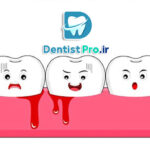 درمان خونریزی مکرر لثه ها چیست؟
