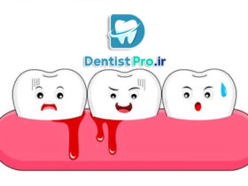 درمان خونریزی مکرر لثه ها چیست؟
