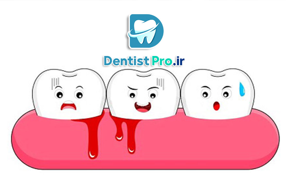درمان خونریزی مکرر لثه ها چیست؟ 25 درمان خونریزی مکرر لثه ها چیست؟