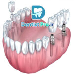 ایمپلنت دو دندان کنار هم؛ راه‌حلی اصولی برای بازسازی لبخند