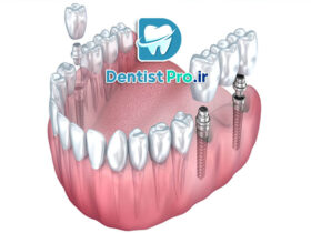 ایمپلنت دو دندان کنار هم؛ راه‌حلی اصولی برای بازسازی لبخند