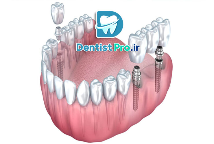ایمپلنت دو دندان کنار هم؛ راه‌حلی اصولی برای بازسازی لبخند