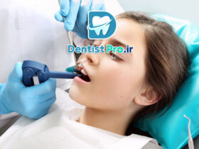 استفاده از سیلانت برای پیشگیری از پوسیدگی؛ روشی مؤثر در حفظ سلامت دندان‌ها