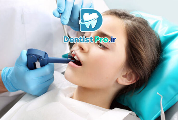 استفاده از سیلانت برای پیشگیری از پوسیدگی؛ روشی مؤثر در حفظ سلامت دندان‌ها