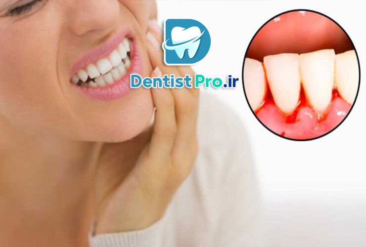 علائم هشداردهنده بیماری لثه+10 علامت هشداردهنده