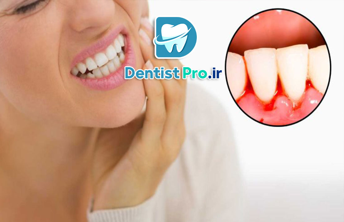 علائم هشداردهنده بیماری لثه+10 علامت هشداردهنده