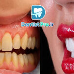 بهترین نوع لمینت برای دندان های حساس: راهنمای جامع و تخصصی
