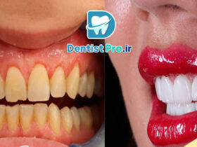 بهترین نوع لمینت برای دندان های حساس: راهنمای جامع و تخصصی