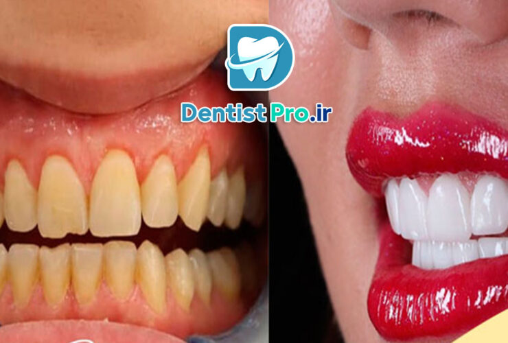 بهترین نوع لمینت برای دندان های حساس: راهنمای جامع و تخصصی