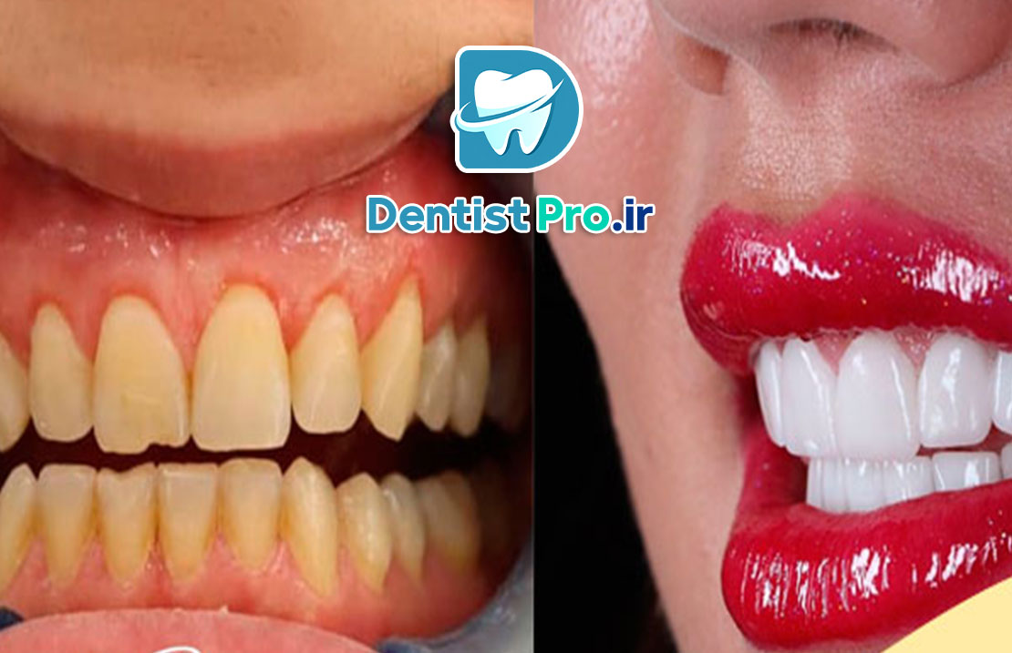 بهترین نوع لمینت برای دندان های حساس: راهنمای جامع و تخصصی