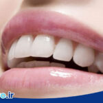 راهنمای کامل لمینت دندان برای مبتدی ها